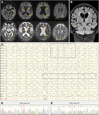 Multidimensional features of sporadic Creutzfeldt-Jakob disease in the elderly: a case report and systematic review